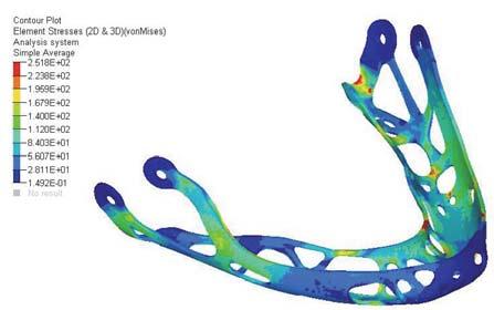 A végleges implantátum geometria kialakítását követ en a mandibulával együtt végeselemes modell építéséhez használtuk fel. A modell építését követ en végeselemes vizsgálatokat végeztünk.