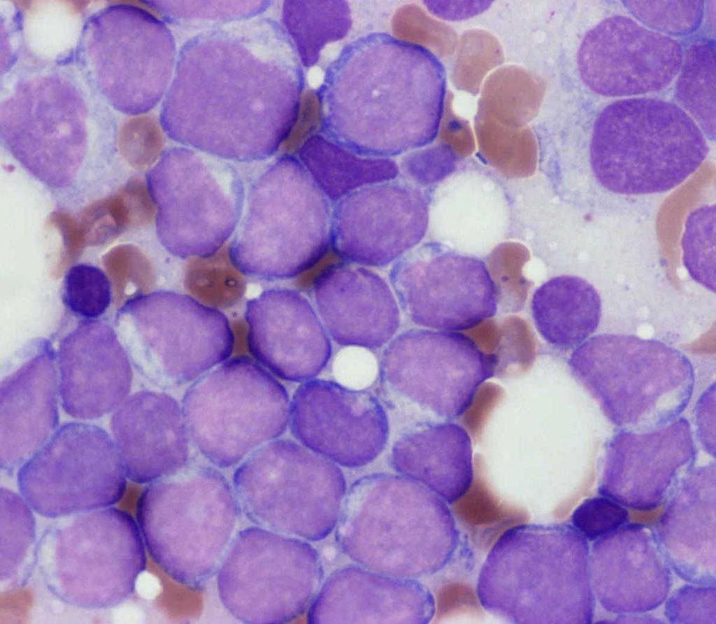 Akut myeloid leukaemia Csontvelő > 20% blast +/- keringő blastok = leukaemiás vérkép > 20% BLAST