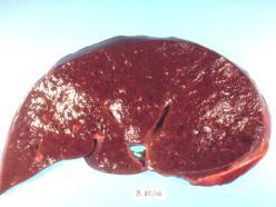 Idiopathiás myelofibrosis Definíció: a csontvelő malignus,