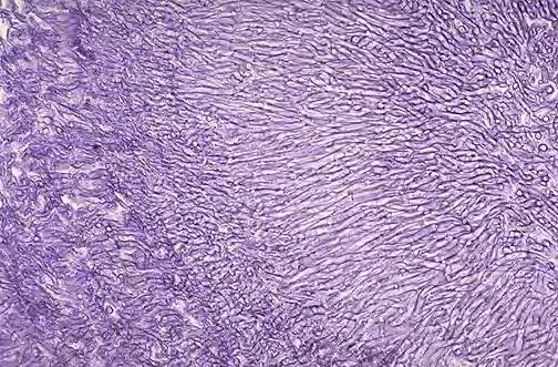 Aspergillosis - hyphák