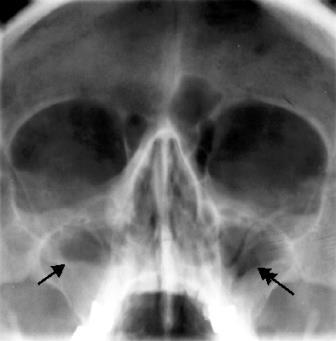Sinusitis