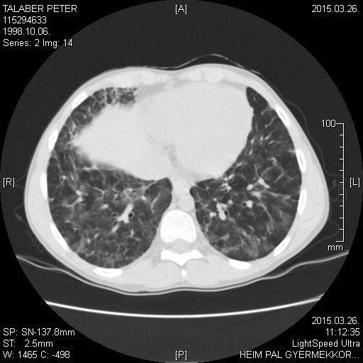 Granulomás tüdőbetegség (GLILD) 2. Kontroll CT (2015. 03. 29.