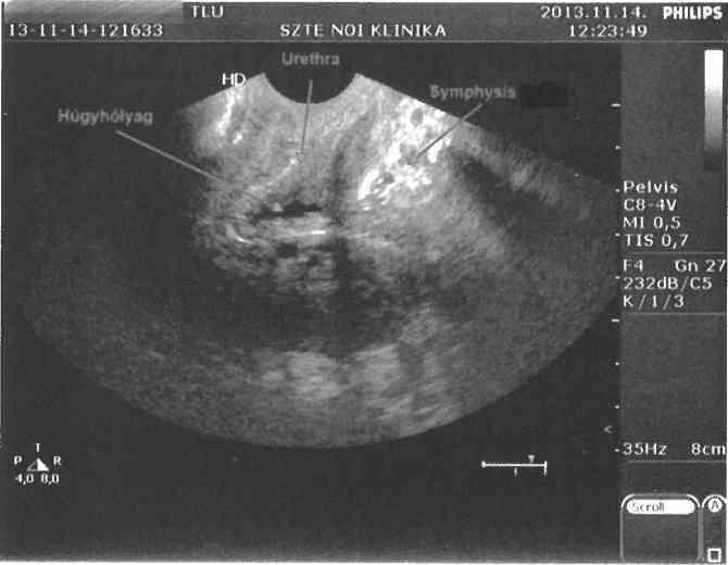 G atizom torna e s ultrahang Pelvic flo o r m uscle training an d ultrasound Surányi A ndrea é s m tsai ANYAG ÉS MÓDSZER A v iz s g á la ti s z e m é ly e k á lta lá n o s je lle m zése: A tréning a