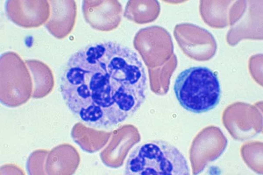 Macrocyter anaemiák MACROCYTER MCV >90 fl Megaloblastos anaemia (B12, folsav hiány)
