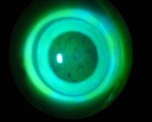 A fluoreszcein-megtartás mértékét az alábbi pontrendszer alapján értékeltem: - Nincs fluoreszcein-megtartás 0 - Igen csekély mértékű, egysejtes foltosodás 0,5 - Egysejtes foltosodás elszórtan a