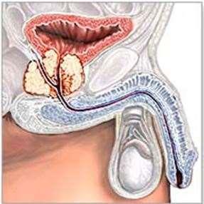 Radikális prostatectomia +/-