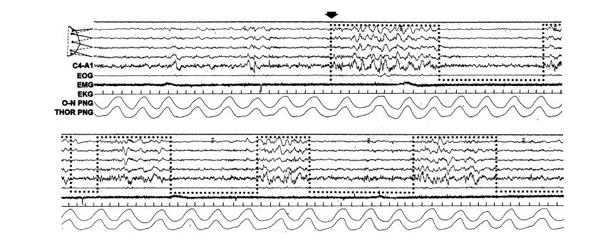 Alvajárás (Szomnambulizmus) (folyt) EEG és viselkedés ellentmondása (mélyen alvó agy, látszólag éber