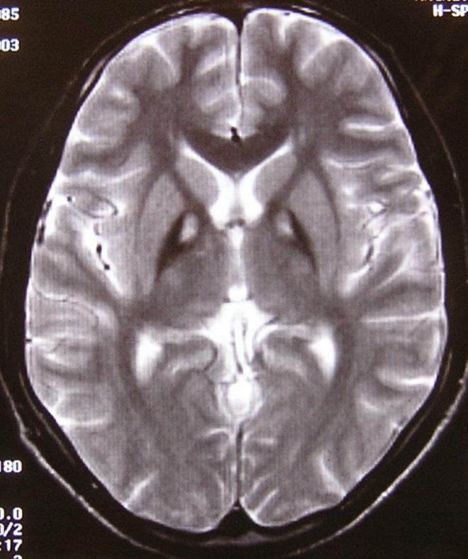 eye of the tiger sign: hyperintenz anteromediális GP