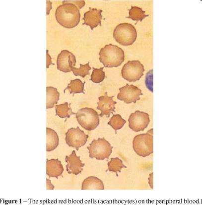 Neuroacanthocytosis Heterogén: HDLD-2, abetalipoproteinaemia, McLeod Személyiség változás,