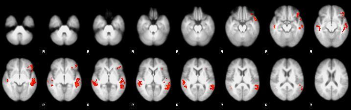 A csoportanalízisben a Z (T/F Gauss eloszlású) statisztikai képek küszöbölése Z>2.3 cluster, és a P=0.05 korrigált szignifikancia küszöbökkel történt. Forrás: Varga és mtsai(2015). 13.
