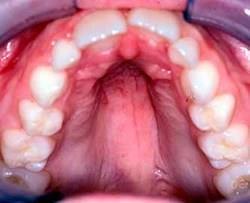 15. ábra - Gótikus szájpad Forrás: https://elementsofmorphology.nih.gov/index.cgi?