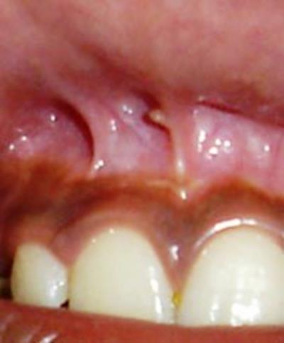 org/wikipedia/commons/thumb/0/0b/Fissured_Tongue. JPG/1024px-Fissured_Tongue.JPG 2.ábra - Többszörös buccalis frenulum Forrás:http://ee_ce_img.s3.amazonaws.