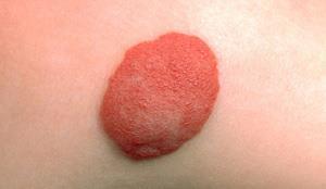 3.ábra - Haemangioma Forrás:http://www.nhs.uk/Conditions/Birthmarks/PublishingImages/haemangioma_300 x174_atb09d.