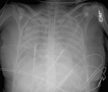 II. Immunológiai szövődmény Transzfúzióhoz társuló akut tüdőkárosodás /TRALI/ 24 órával később Anteroposterior chest radiograph from a