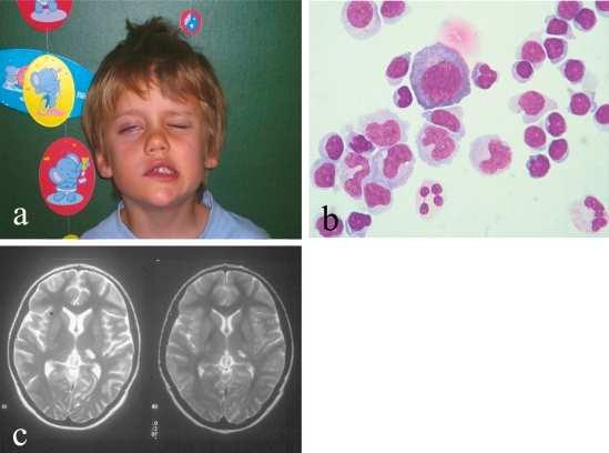 Lyme kór k r manifesztáci ciói i a központi idegrendszerben a Faciális paresis b Pleocytosis c