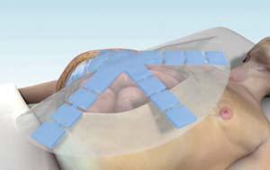 JEGYZET The ABThera TM System is specifically designed to help