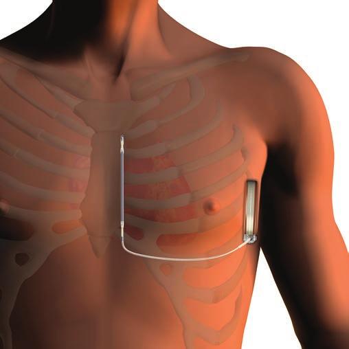 Bevezetés A hirtelen szívhalál (SCD = sudden cardiac death) egyik leghatásosabb kezelését ma a beültethető kardioverter defibrillátorok (ICD) primer és szekunder prevenciós al kalmazása jelentik,