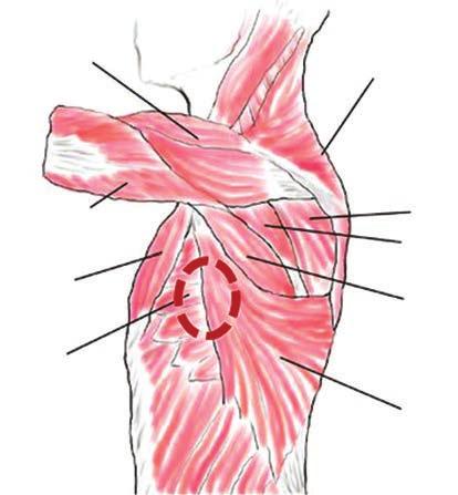 deltoideus triceps brachii pectoralis major serratus anterior trapezius infraspinatus teres minor teres major latissimus dorsi 2. ÁBRA. Az S-ICD-telep anatómiai lokalizációja a M.
