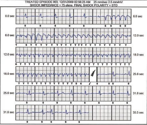 4. ÁBRA. Pleomorf kamrai tachycardia adekvát detekciója és sikeres sokk-terápiája (saját anyagból) mint ahogy azt megszoktuk a hagyományos ICD-knél.