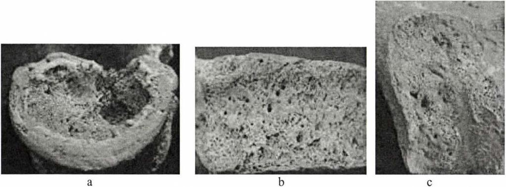 18. sír, felnőtt (Maturus, Mat.) férfi csontváza (a 3 minta EURAC azonosítói: ID 1196-1198). A csontvázon spondylitis tuberculosa nyomai valószínűsíthetők (la. ábra).