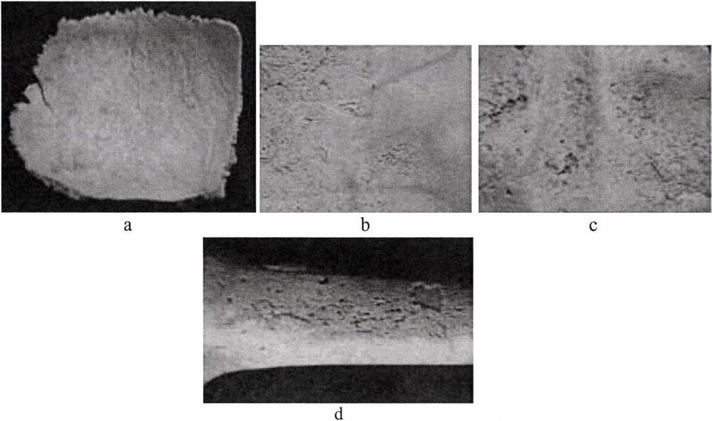 Figure 2: Periostitis (periosteal appositions and remodelling) on left rib visceral surfaces, indicating probable pleuro/pulmonar TB.