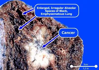 carcinomák proliferációjában,