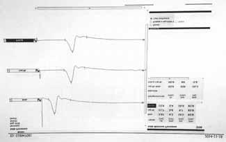 A fehér négyzetben a helyzetváltoztatás okozta műtermék látható Picture 4. Graph of veno-arterial reflex examination. There is the value of flow during relaxation (16.