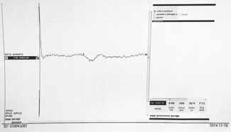 A DIABETESES LÁB KOMPLEX VIZSGÁLATA 6. kép. Érző ideg vizsgálata a nervus suralison Picture 6.