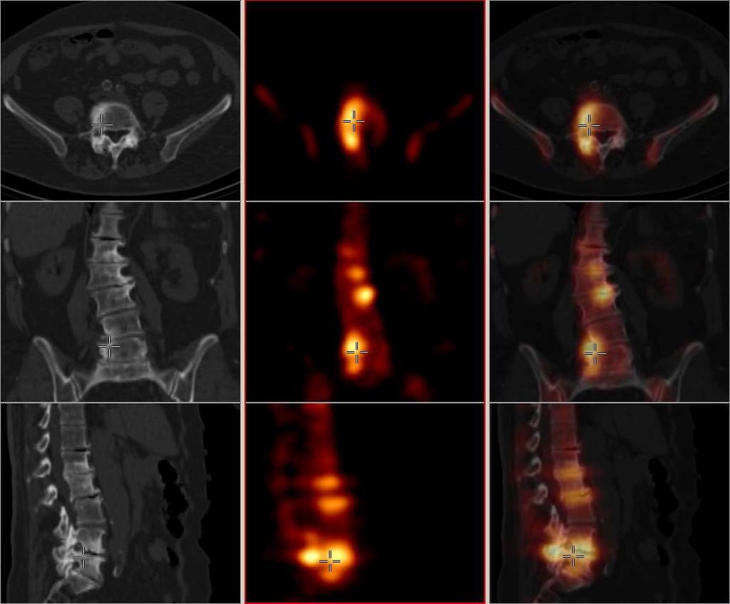 SPECT + CT fúziója 2007-től