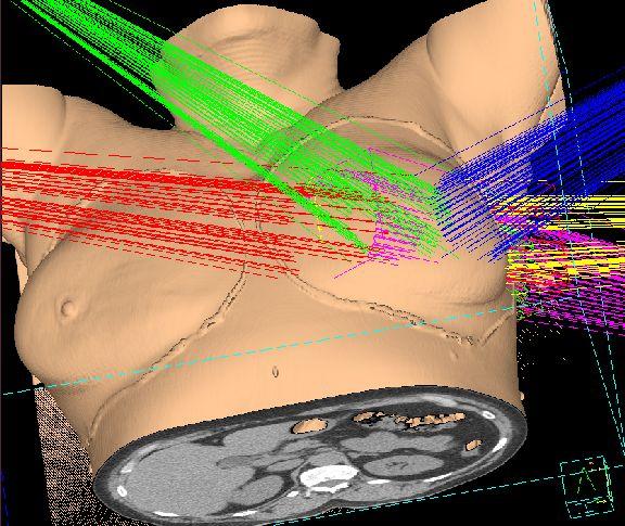 36,9 Gy (9 x 4,1 Gy/5 nap) 3D-KRT Strahlenther