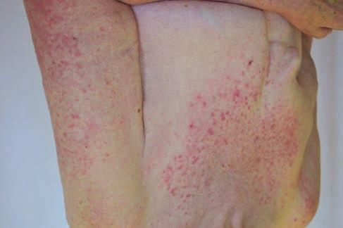 1. ábra Élénk erythemas, urticariform maculo-papulosus exanthema (közelkép a jobb felkarról), a háton linearis jelleggel gyógyászati, gasztroenterológiai, reumatológiai, fül-orr-gégészeti és