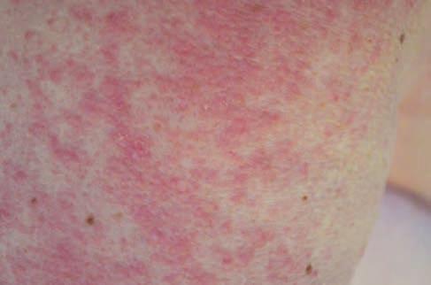 Ferritin értéke extrém magas volt (30489 ng/ml), míg többi labor értéke nem volt kóros.
