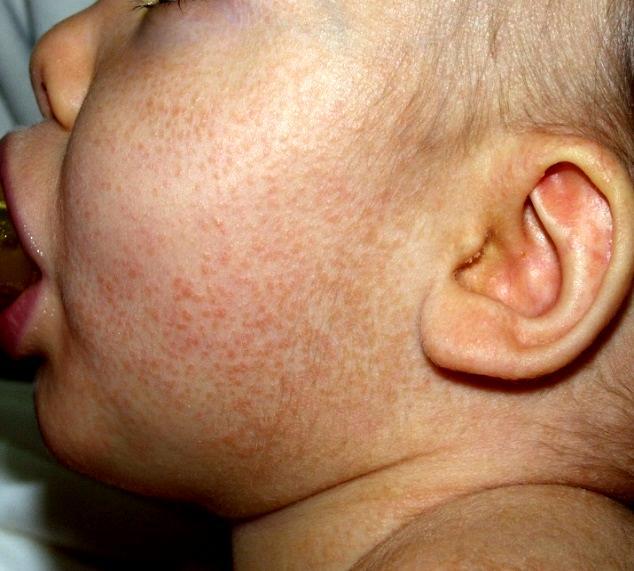 Seborrhoeás dermatitis csecsemőkori formája