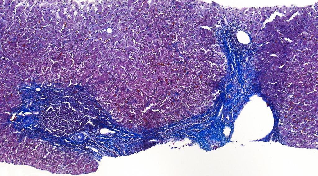 Fibroticus sövény (kék) köt össze