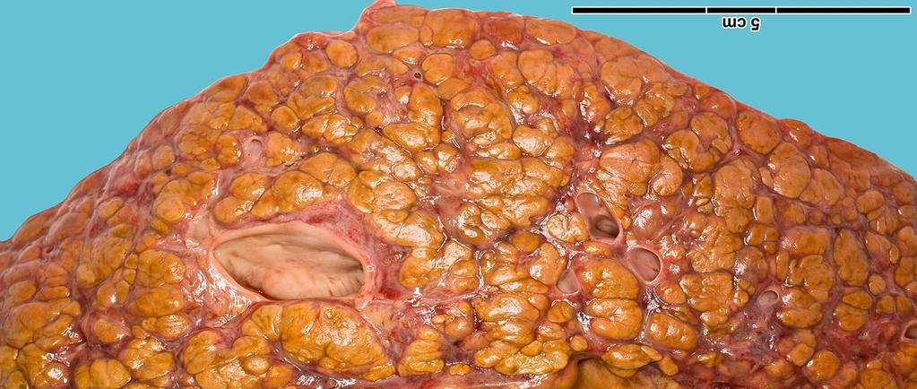 Macronodularis cirrhosis Fibroticus sövények