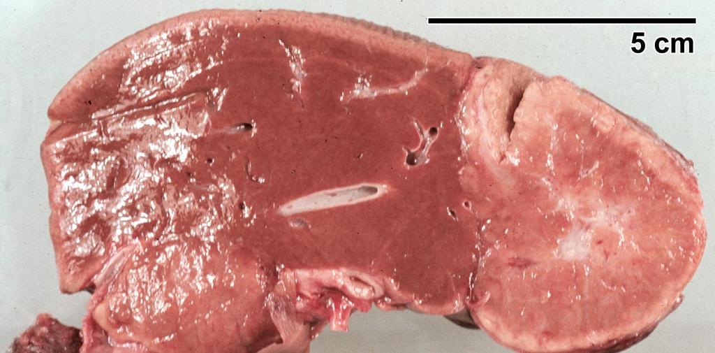 Focalis nodularis hyperplasia Fogamzásgátlót szedő nőkben