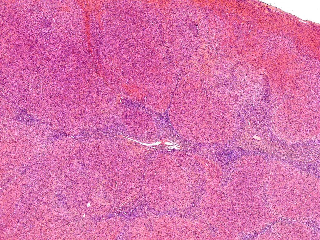 Focalis nodularis