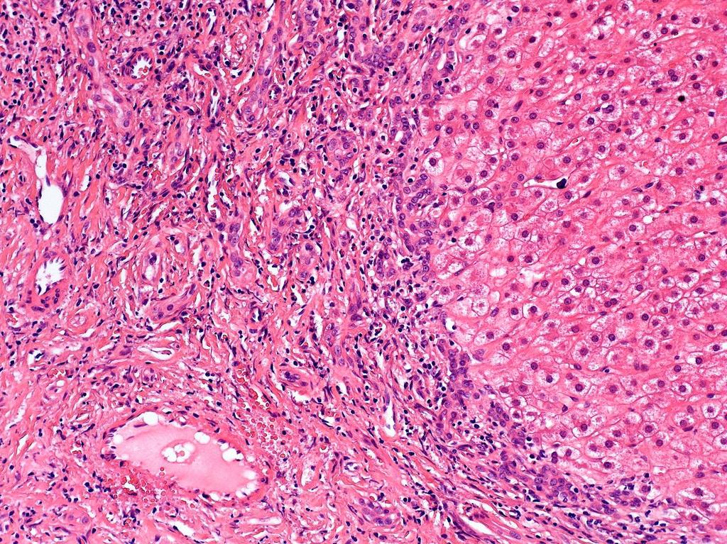 Focalis nodularis hyperplasia: a portalis mezőt utánzó