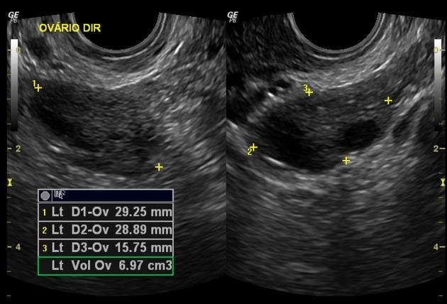 húgyhólyag, aminek el kell érnie az uterus fundusát, így ez lehetővé teszi a méh, ovarium és a Douglas-üreg ábrázolását.