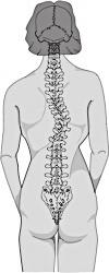 76 Útitárs IX./2.4 Scoliosis Scoliosis: A gerinc oldalirányú elváltozásával járó deformitás.