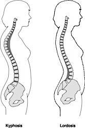 18.ábra: Fokozott háti kyphosis és fokozott ágyéki lordosis IX./2.