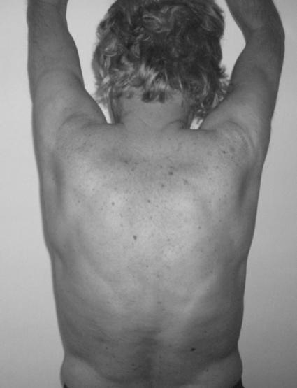 A betegség megnevezésekor több szinonima is használatos, mint az Otseochondrosis juvenilis dorsi és a Kyphosis dorsalis juvenilis.