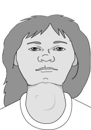 megnagyobbodott. Struma nodosa (göbös struma) esetén viszont a túlzott raktározás csak a mirigyállomány egyes részeit érinti. A göbös golyva rendszerint tapintható.