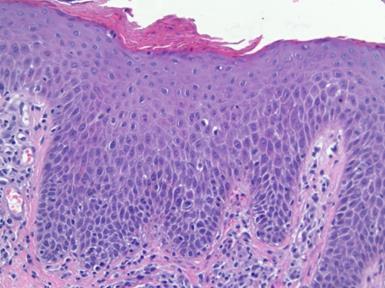 spongioticus mintázat - ekzema Szöveti kép változó - krónikus spongiosis Kompakt hyperkeratosis Parakeratosis -/minimális Acanthosis Minimális spongiosis