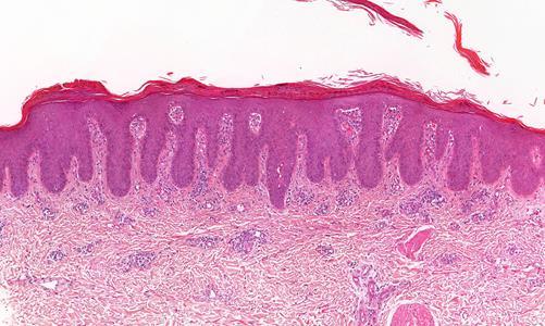 Acanthoticus mintázat - psoriasis Szöveti kép Parakeratosis Reguláris acanthosis Neutrophilek a stratum corneumban/epidermisben Granuláris réteg