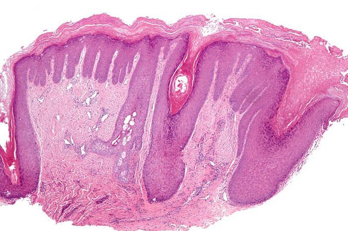 Acanthoticus mintázat -