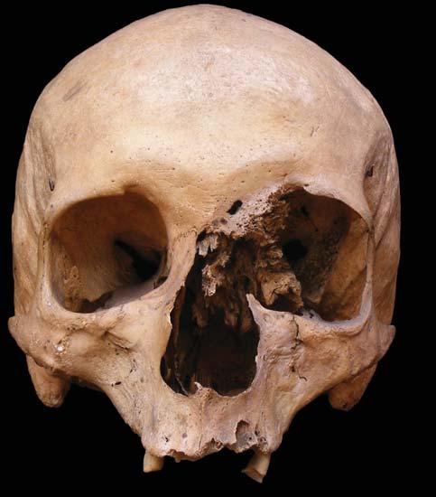 162 Speciális szempontok 4. kép. Spiculum scanning elektronmikroszkópos képe Az osteosarcomára jellemző csonttüskék (Kr. u. XI XII. sz., Pusztapáka-Nándorhalom lelőhely, 40 50 éves nő). 2. kép. Craniofacialis osteosarcoma Rosszindulatú csontdaganatra utaló laesiók egy középkorú nő orrüregében és bal orbitájában (Kr.