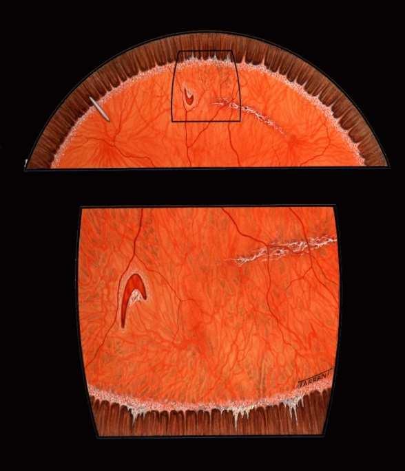 Pars Plicata Vitreous base Pars