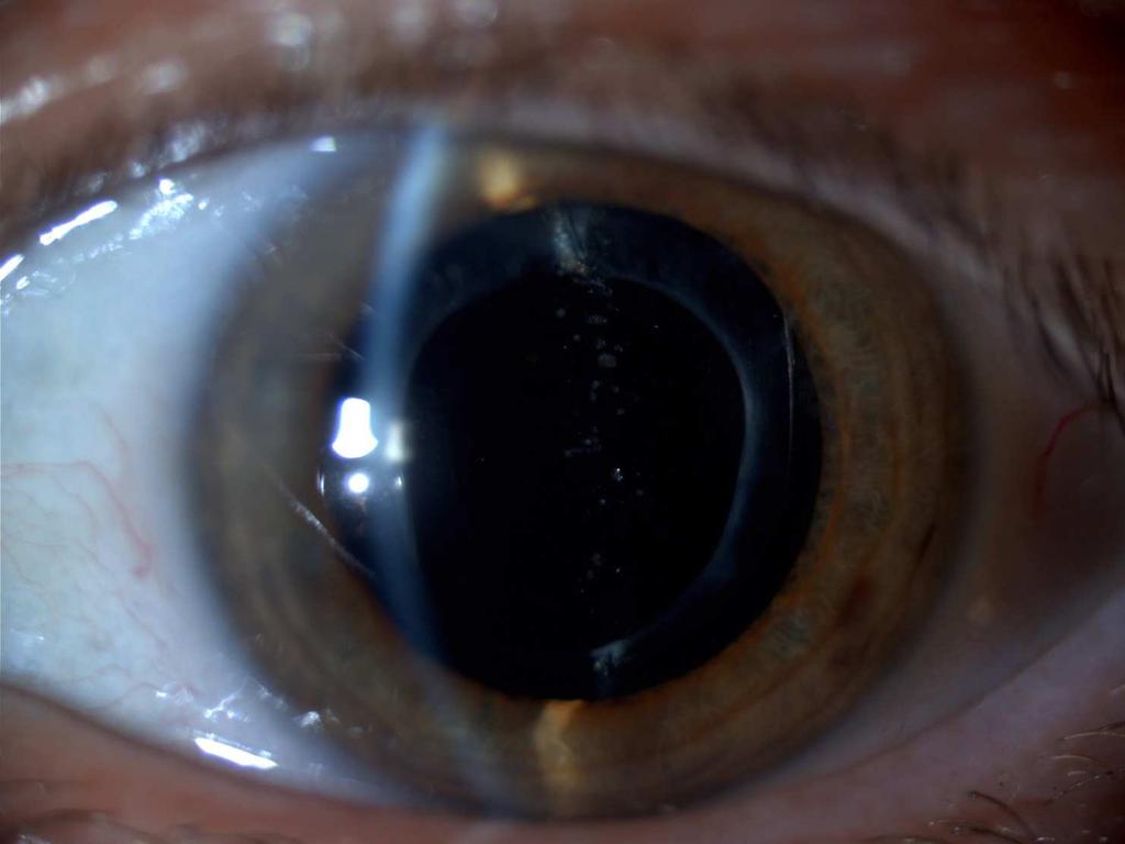 diabetes retinaleválás kezelésére látás látás diabétesz kezelésében