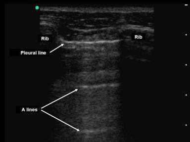 Az A-vonalak a pleurával párhuzamos, fehér vonalak, melyek a mélyebb régióban, de mindig a bőr és a távolság () többszörösére húzódnak.